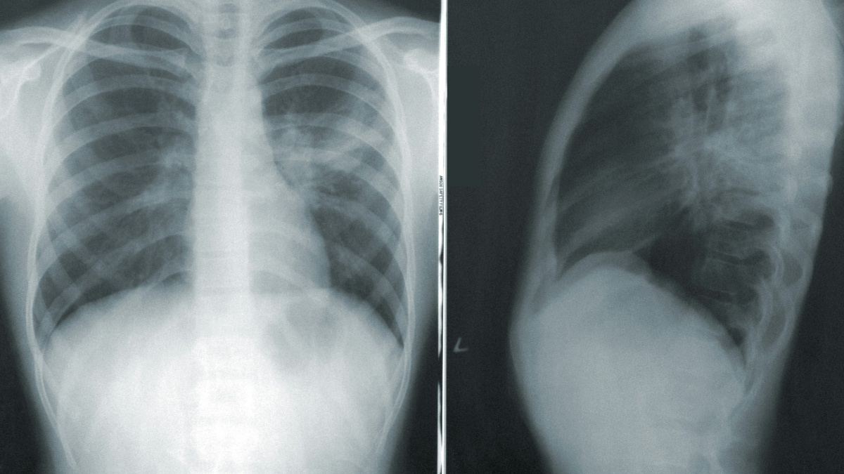 El gas radón se relaciona con la aparición de cáncer de pulmón (Foto: Unsplash)